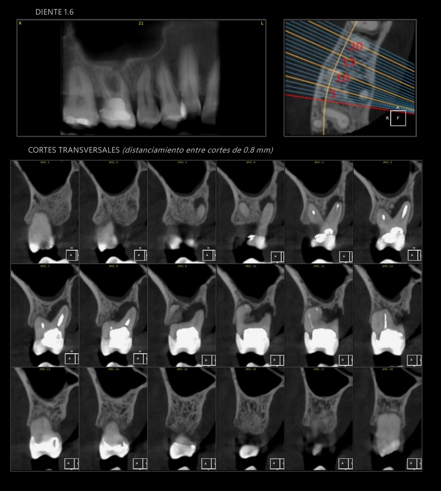 Placa CBCT con cortes transversales